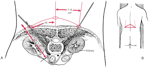 Coeliac plexus injection