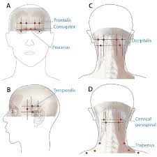 Injections around nerves