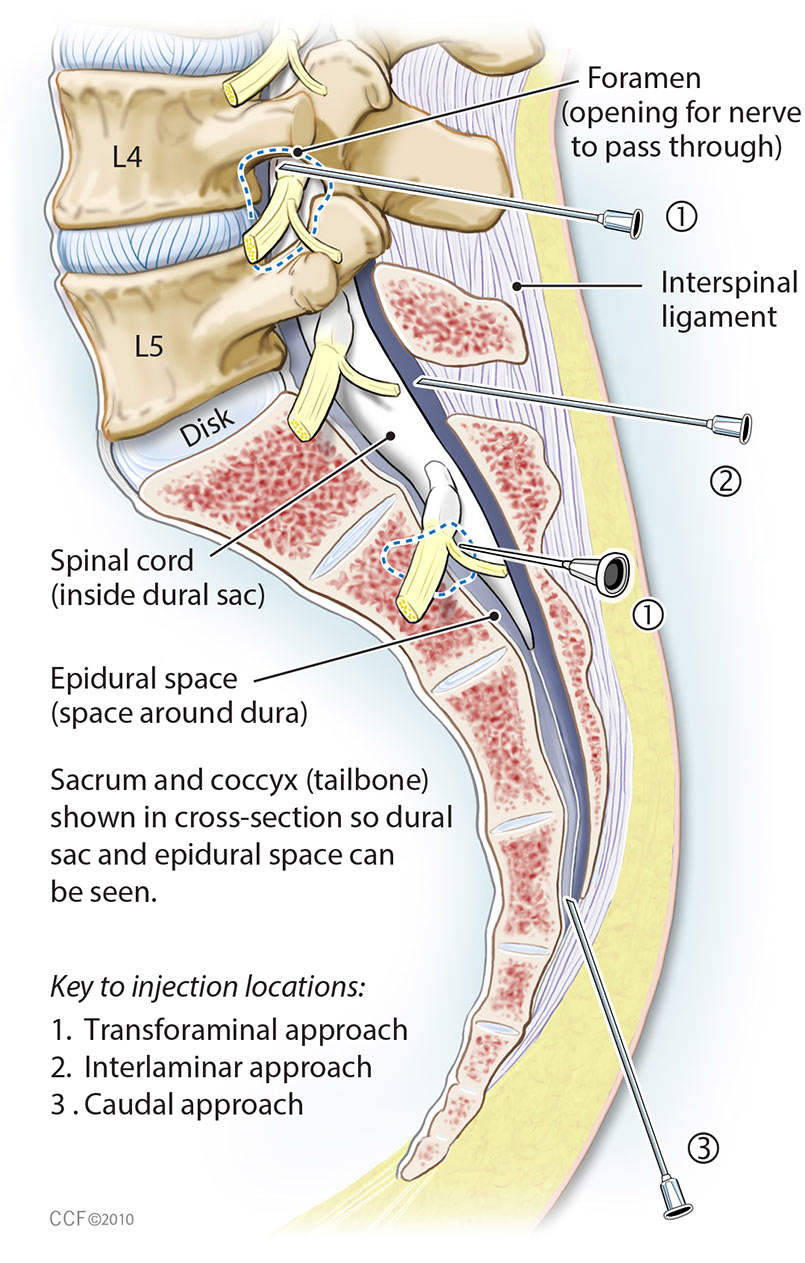 Lumbar epidural injection