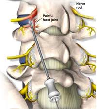 Lumbar facet injections
