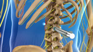 Lumbar Sympathetectomy