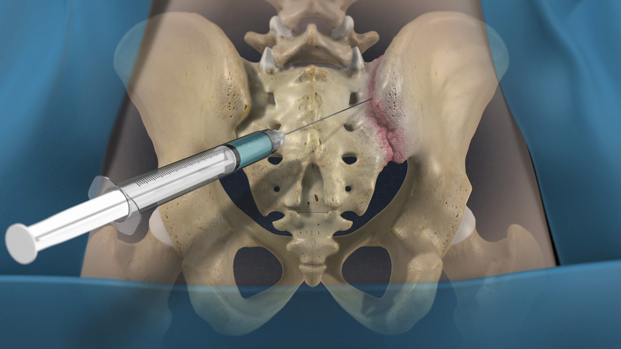 Sacro-iliac joint injections