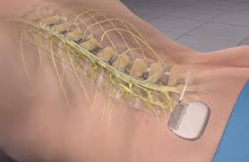 Spinal Cord Stimulation