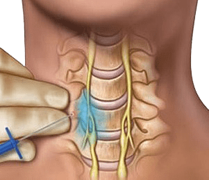 Stellate Ganglion Block